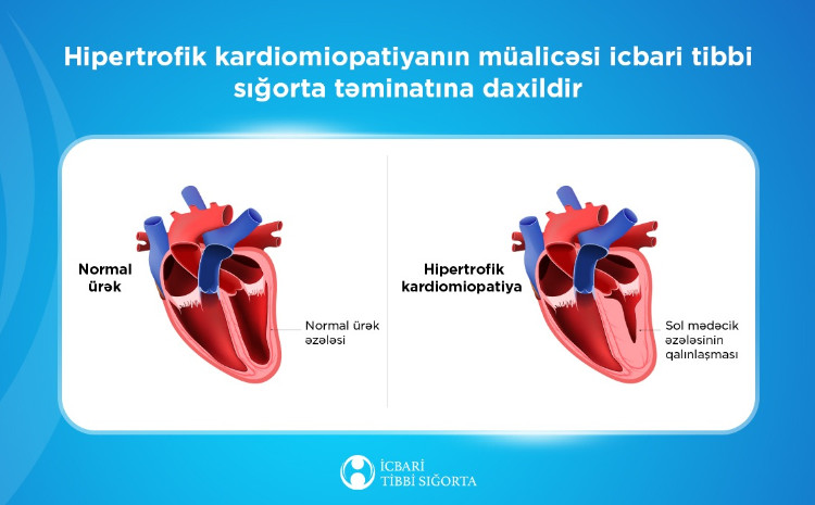 Hipertrofik kardiomiopatiyanın müalicəsi icbari tibbi sığorta təminatına daxildir 